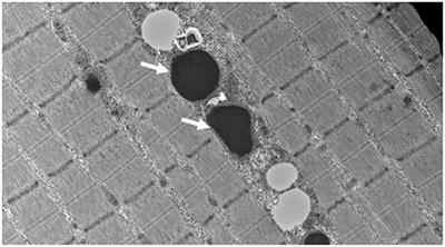 Expanding the Clinical Spectrum of LONP1-Related Mitochondrial Cytopathy